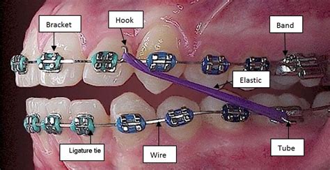 The Different Parts of Braces and What They Do · Hansen Ortho